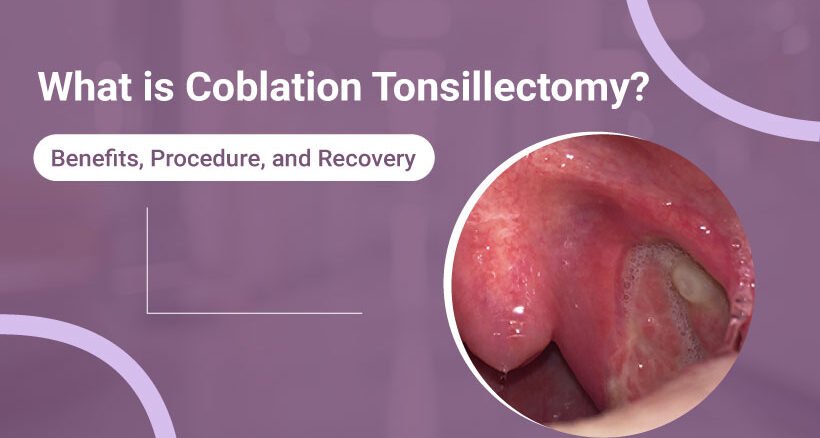 Coblation What is Coblation Tonsillectomy? - Dr Simple Bhadania | Yoomark
