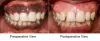 Gingival Depigmentation with Dental Lasers for Management of Gingival Hyperpigmentation