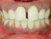Gingivoplasty Using Diode Laser