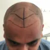 Best Hair Treatment in Bangalore | Hair Transplant Consultation