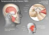 TMJ disorder specialist
