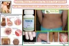 10 Natural Remedies for Lichen Planus - Herbal Care Products - Blog