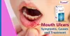 Oral Rinse Medicine For Mouth Ulcers | Canker Sores | Painful Sores 