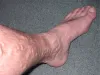 Varicose Veins - Can Be Permanently Cured Or Not? - Vein Clinics TX : powered by Doodlekit