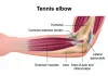 Epicondylitis - Causes, Symptoms and Treatment