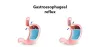 Best Gastro Surgeon in Hyderabad | Gastroesophageal Reflux Disease