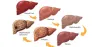 Best Gastro Doctor in Hyderabad | Alcoholic Liver Disease