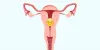 Diminished Ovarian Reserve: What Does It Mean? 