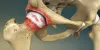 Types of Arthritis that Affect the Hip