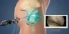 What to Expect During Your Hip Labral Tear Recovery