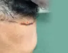 Hair Transplant From Beard Area To Scalp