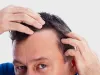Hair Regrowth Treatment in Delhi, Best Hair Loss Treatment in Delhi, India