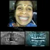 Upper Jaw Fixed Teeth with implant - Trisa Dental Solutions
