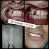 Teeth in an Hour @ low cost | Nobel Biocare Dental Implant 