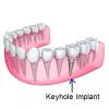 Keyhole Dental Implants in Mumbai | Trisa Dental Solutions 