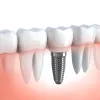 Dental Implants London, ON | Highly Rated Dental Implant Dentist