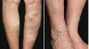 How To Get Rid Of Spider Vein To Improve Appearance? | What Is The Science Behind The Varicose Veins?