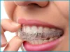 Adept Creation: What Are The 4 Types Of Braces For Child Straight Teeth?