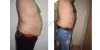Liposuction Surgery & Treatment Delhi, NCR| Resplendent Cosmetics