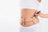 Who is Best Suited for Liposuction?