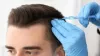 What you need to know about FUE Hair Transplant Procedure