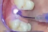 How do implant doctors use dental laser effectively？