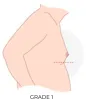 Stages of Gynecomastia | Grade of Gynecomastia - Dr Hasan