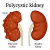 Polycystic Kidney Disease (PKD) Symptoms and Treatment in Ayurvedic