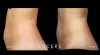  SculpSure Treatment for Body Contouring in Edmonton