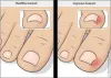 What Causes Ingrown Toenail And How to Cure it?