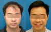Per Graft Cost of Hair Transplant Dubai - hairtransplantdubaiae’s diary