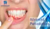 Treatment of Advanced Periodontics | Paramountdental Specialty