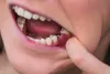 Resolve Your Missing Tooth Issues With a Dental Implant - holisticdentalau’s blog