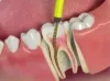 Root Canal Treatment