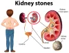 Types Of Kidney Stone