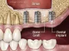 Bone Grafting, Bone Loss treatment  | Trisa Dental Solutions 