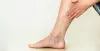 Is it worth getting varicose veins removed?