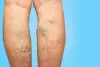 What are the different types of varicose veins?