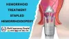 Stapled Hemorrhoidopexy: A Modern Approach to Treating Hemorrhoids