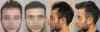 Best FUE Hair Transplant in Dubai &amp; Abu Dhabi | Male &amp; Female | Hair Transplant Clinic
