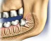 Five Tips To Prevent Gum Disease - emergencydentistinhouston