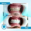 All on Six Implants Turkey -Procedure, Photos, Reviews| Okutan