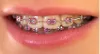 Why Choose Dental Implants?