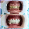 Dental Care in Turkey-Types&amp;Clinic Practices | Okutan Dental