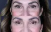 fraxel treatment