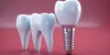 How Much Do Dental Implants Cost in Indianapolis - Ruli
