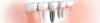 What are Implants &amp; Their Advantages | Dental Implants in Pune, Mukundnagar