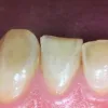 Porcelain Dental Veneers | Veneers Rochester Hills Michigan Troy