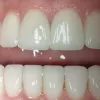 Porcelain Dental Veneers | Veneers Rochester Hills Michigan Troy