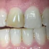 Porcelain Dental Veneers | Veneers Rochester Hills Michigan Troy